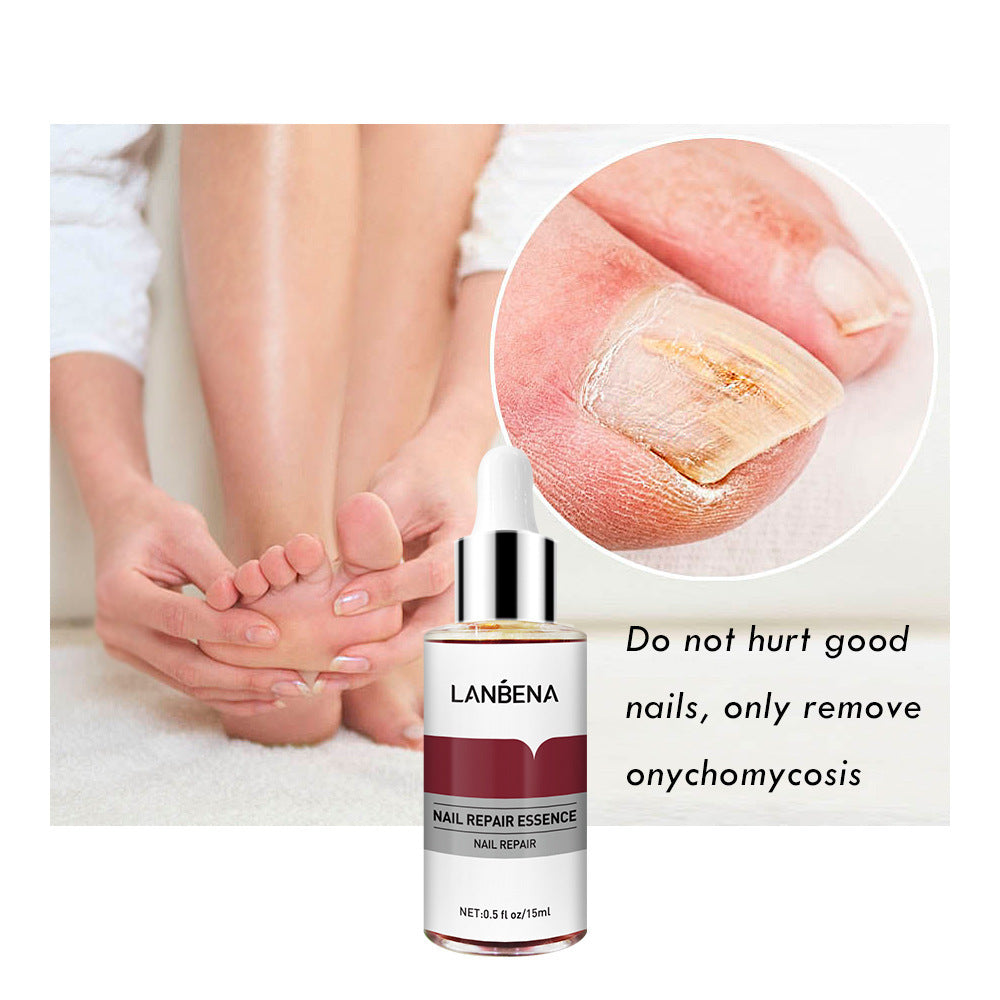 Nail Repair With Small File 15ml Anti-Onychomycosis Foot